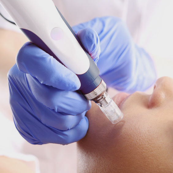 Micro Needling