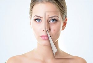 Adult Acne
